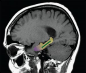 Hippocampal region