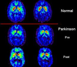 PET scan of Parkinson's patient